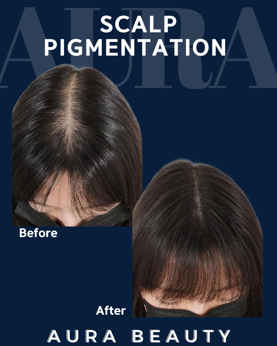 Scalp micropigmentation: density and parting recovery on female crown.