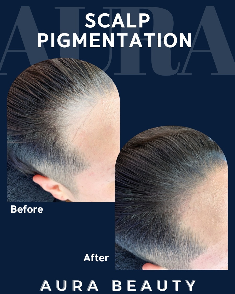 Scalp micropigmentation: hairline restoration on male client.