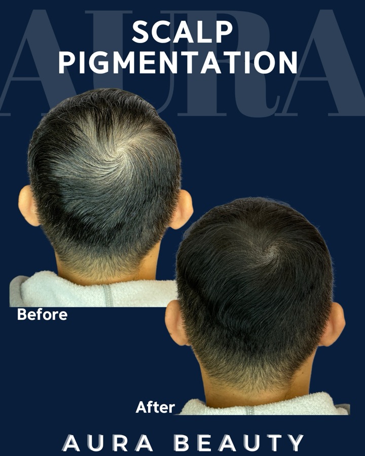 Aura Beauty Scalp Pigmentation: hairline density restoration on male crown, before and after.